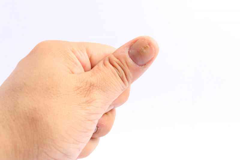 nokti s crnim mrljama