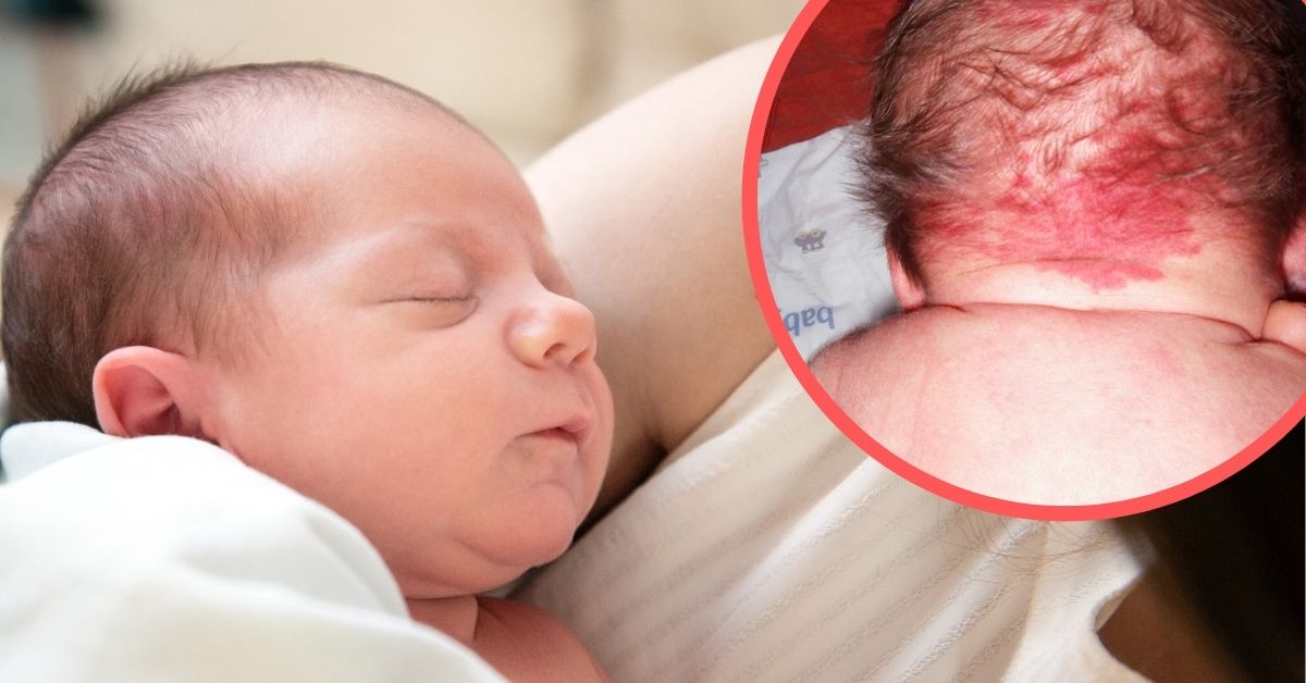 Poljubac Anđela Ili Ujed Rode Gde Se Nalazi I Kako Izgleda Beleg Koji Ima Svaka Treca Beba Bebac Com